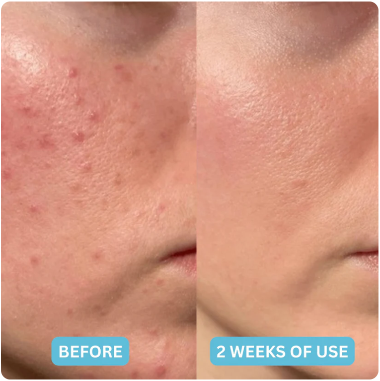 HealPro™ Hydrocolloid Roll